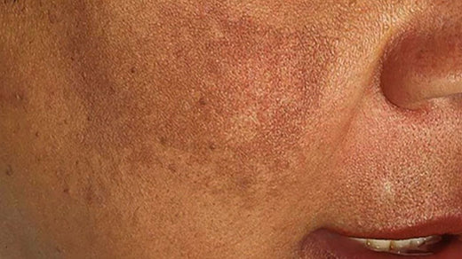 HOW TO TREAT HYPERPIGMENTATION